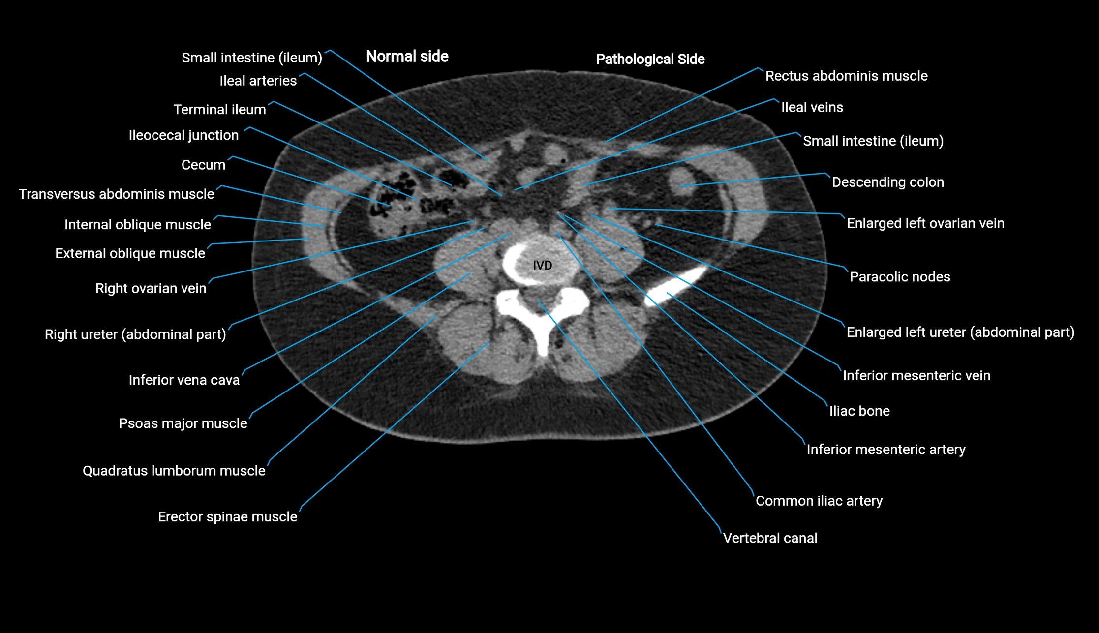 CT KUB axial cross sectional anatomy  radiology image -img-00201-00094.webp